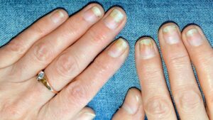 How Do You Heal a Damaged Nail